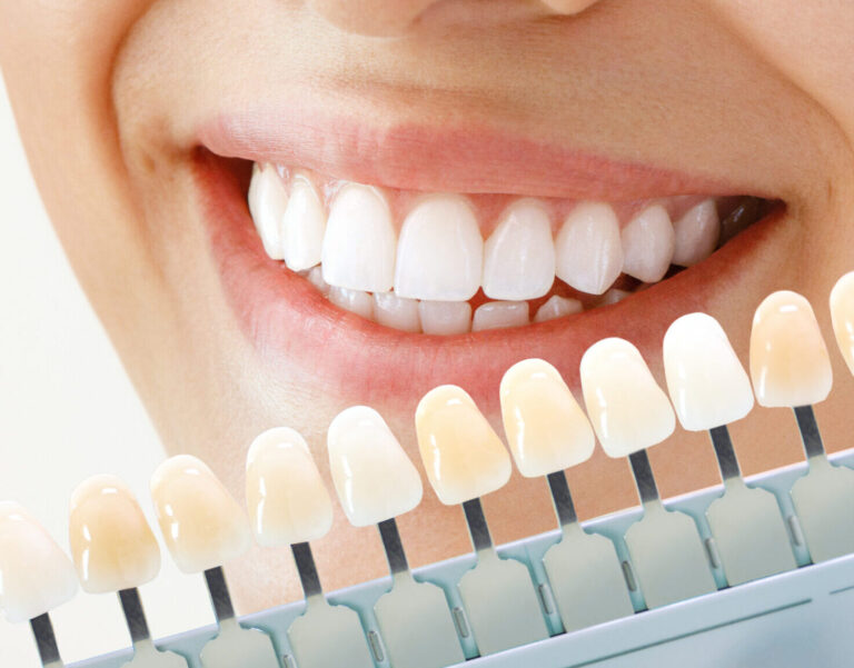 Smiling young woman. Cosmetological teeth whitening in a dental clinic. selection of the tone of the implant tooth